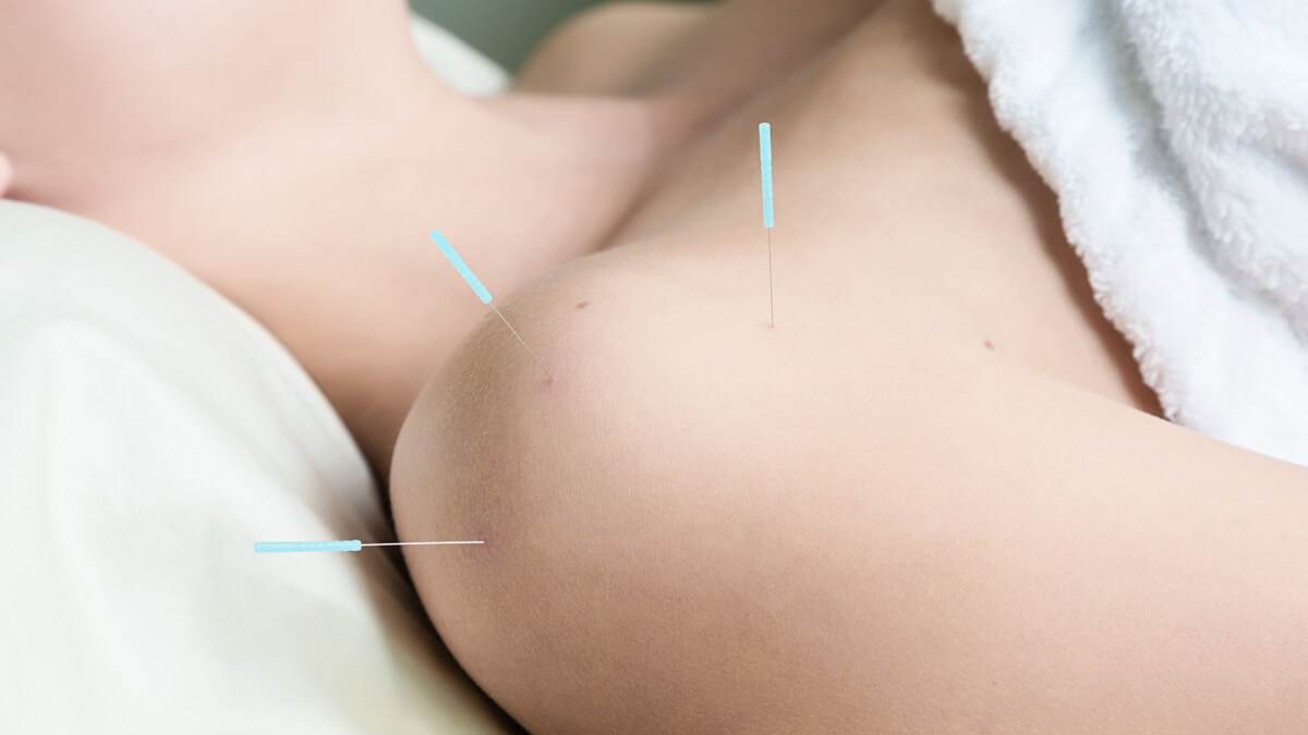 Dry needling by massage therapist Colleen Gould at Weston Creek Chiropractic Centre